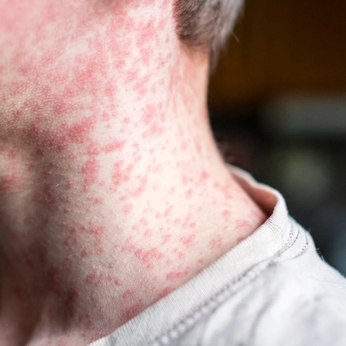 São Paulo tem 40 casos de sarampo; 36 deles são na capital